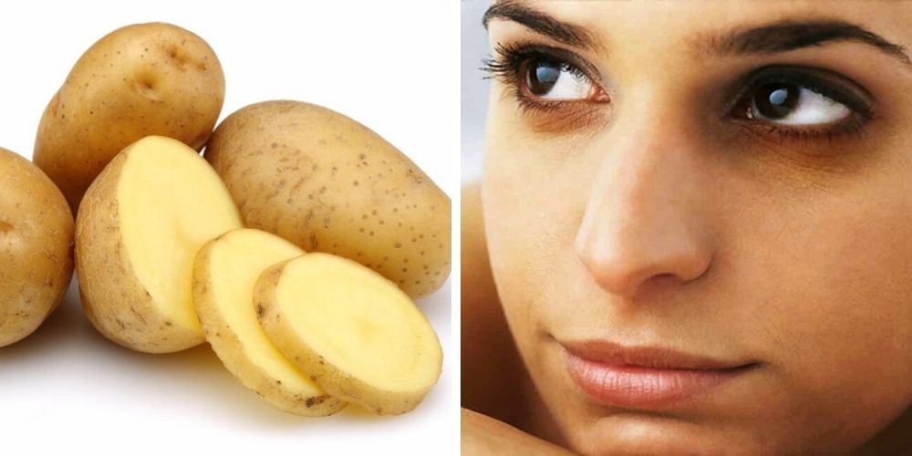 ✅ Cómo deshacerse de las horribles ojeras usando patata ✅