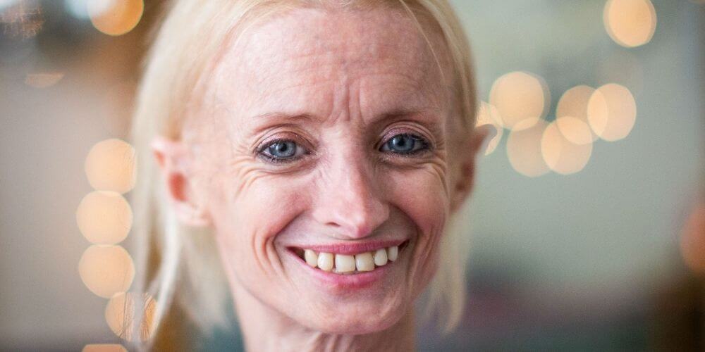esta-mujer-envejece-8-veces-mas-rapido-de-lo-normal-debido-a-una-enfermedad-progeria-movidatuy.com