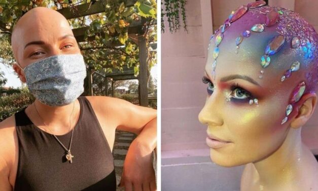 ✌ Hermosa mujer que sufre de alopecia muestra su calvicie al mundo con mucho orgullo ✌