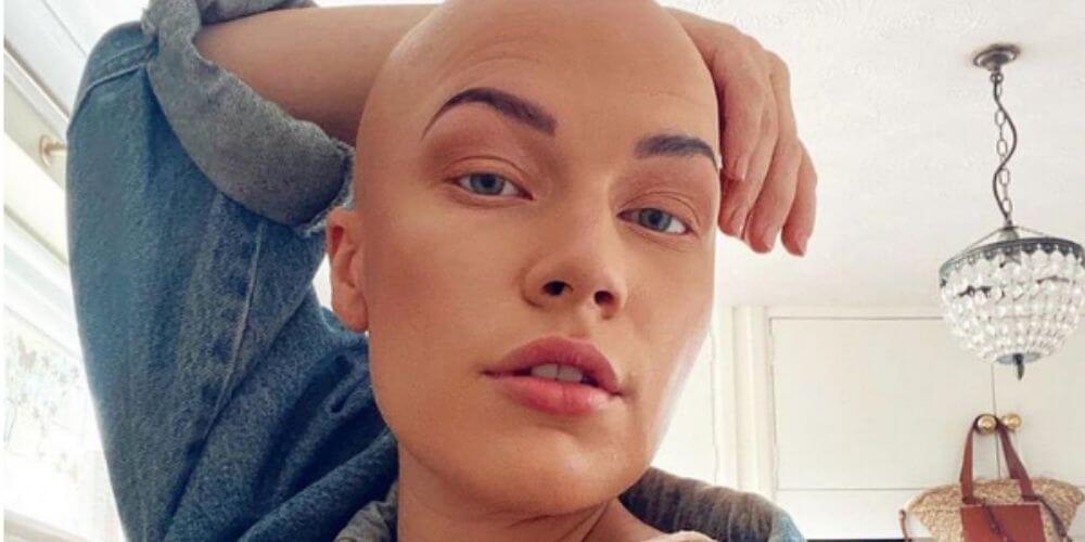 hermosa-mujer-que-sufre-de-alopecia-muestra-su-calvicie-al-mundo-con-mucho-orgullo-jess-newman-movidatuy.com