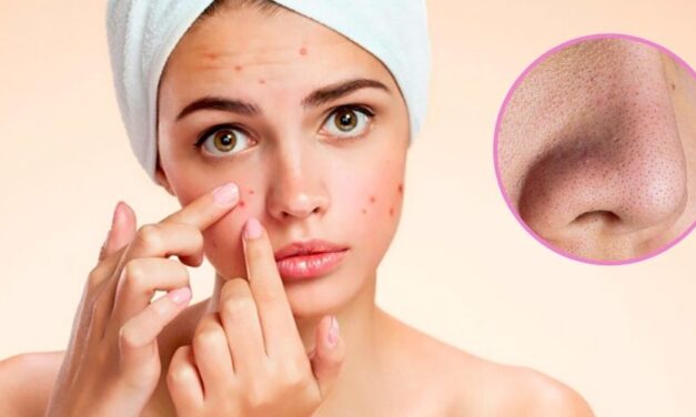 ✅ Deshazte de los puntos negros con estas estupendas mascarillas naturales ✅