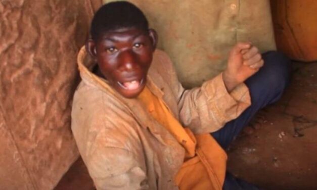 😮 El Mowgli humano, así le dicen a un joven con microcefalia 😮