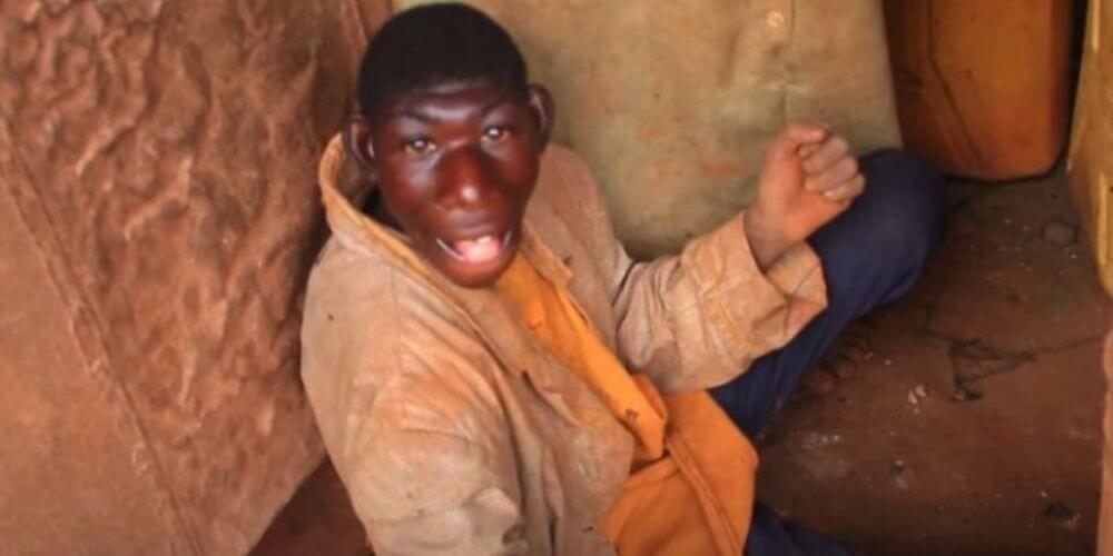 😮 El Mowgli humano, así le dicen a un joven con microcefalia 😮