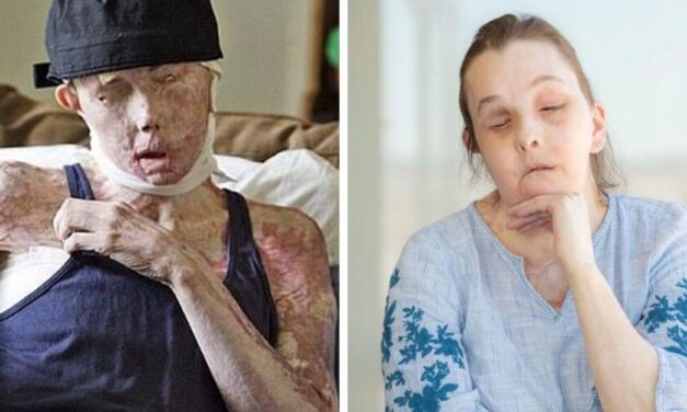 ✌️ Carmen es la primera persona en recibir trasplante de cara en EE.UU ✌️