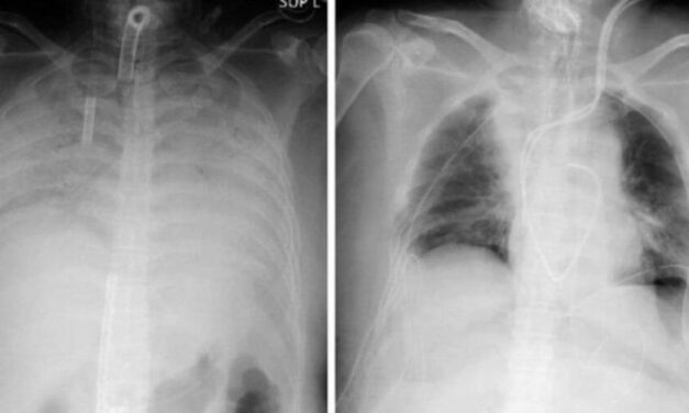 😮 Médicos japoneses hacen el primer trasplante pulmonar con donantes vivos 😮