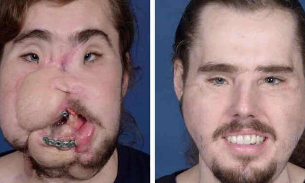 ✌️ Joven recupera su vida después de someterse a un trasplante de cara ✌️