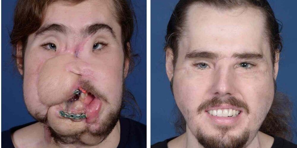 ✌️ Joven recupera su vida después de someterse a un trasplante de cara ✌️