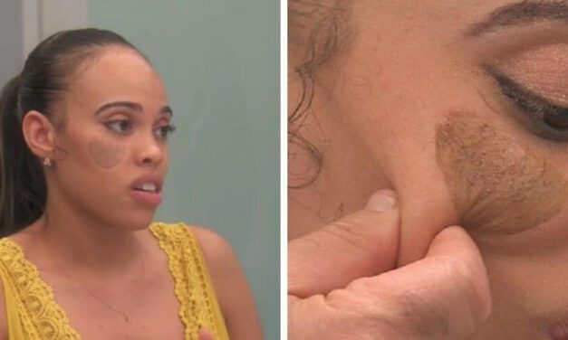 😮 A esta mujer le comenzaron a salir vellos púbicos en la cara luego de un injerto 😮