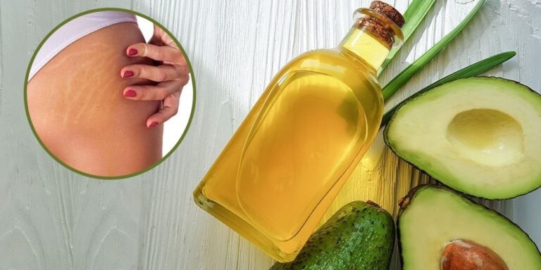 Conoce Los Remedios Naturales Más Efectivos Para Eliminar Las Estrías 0555