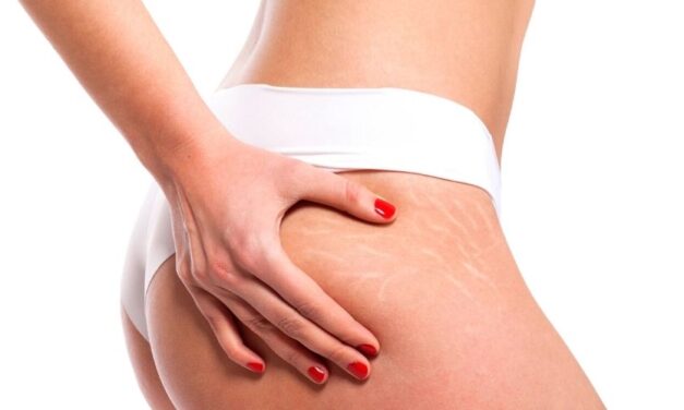 ✅ Conoce los remedios naturales más efectivos para eliminar las estrías ✅