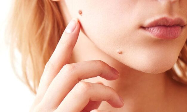 ✅ ¿Cómo eliminar las verrugas en casa con remedios naturales? ✅