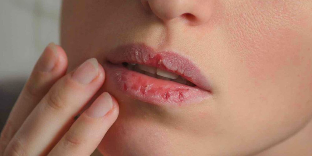 labios-agrietados-como-curarlos-e-hidratarlos-de-forma-natural-mujer-con-labios-agrietados-y-cortados-salud-movidatuy.com